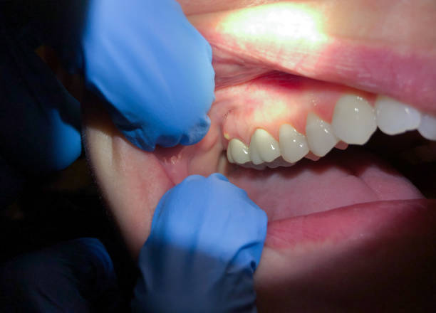Best Emergency Tooth Extraction in Huntley, IL